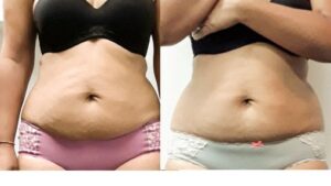 Before and After Fat Cavitation belly 4