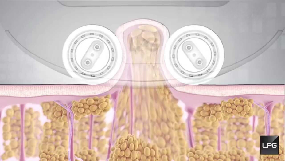 HOW DOES lpg endermologie WORK