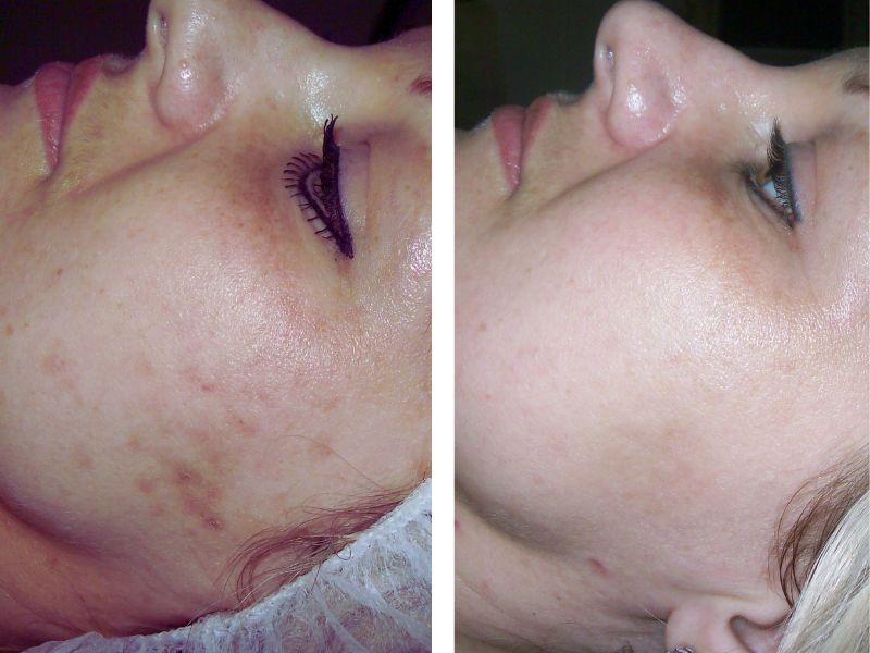 Microneedling with Dermapen - Best skin needling for collagen stimulation